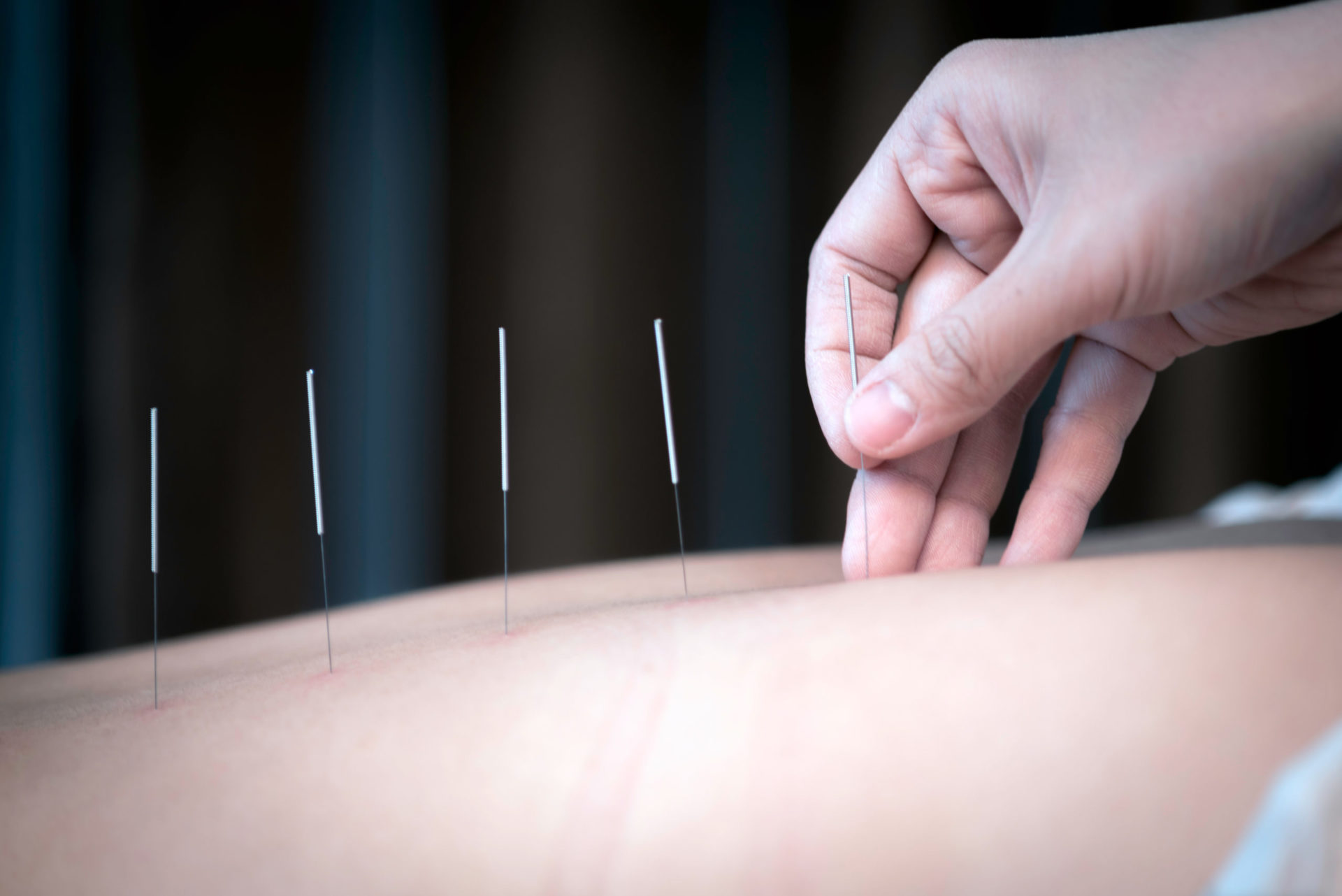 Quel est le statut juridique de l’acupuncture en Belgique ?